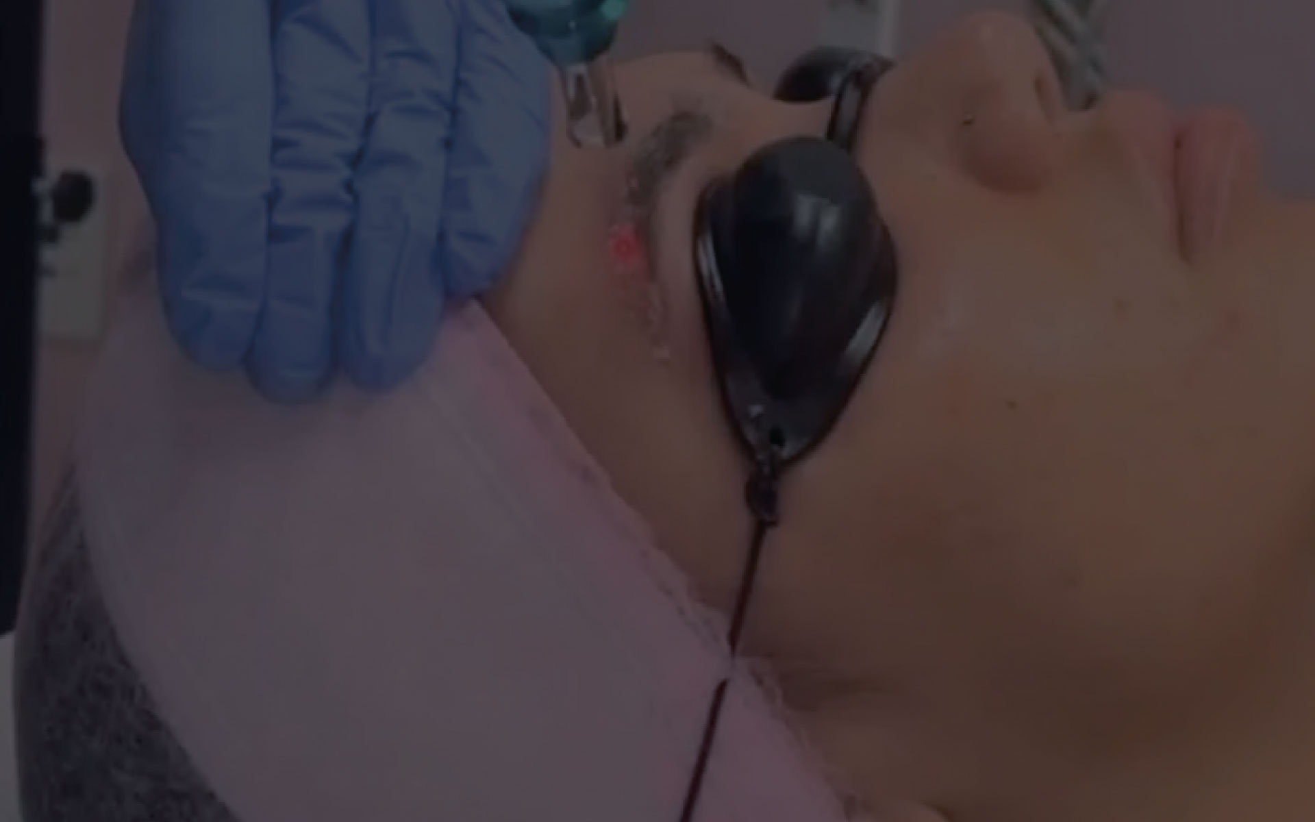 Eliminación de cejas